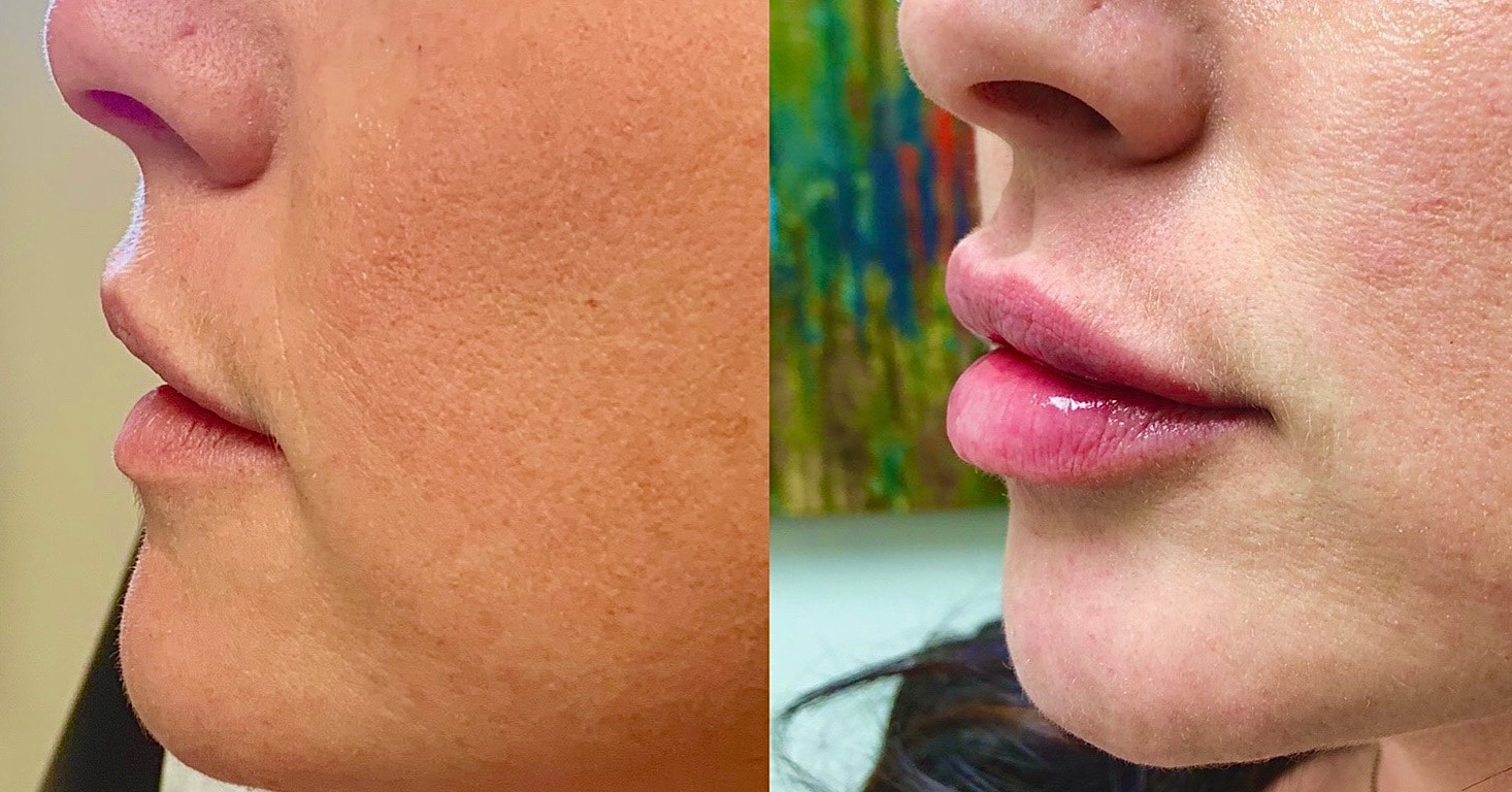 Patient before and after lip filler photos